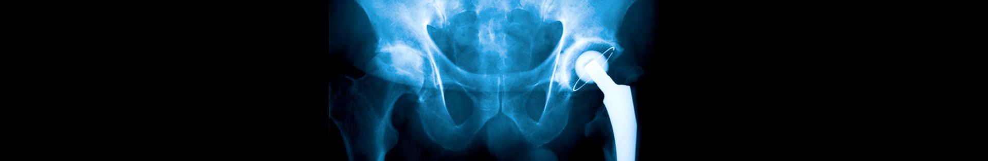 Tampa Metal Hip Implant Attorneys