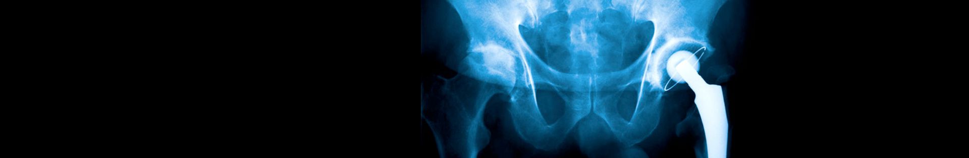 Metal-on-Metal Hip Implants